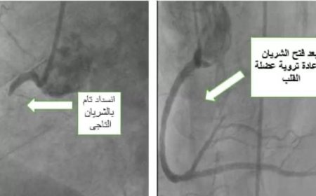 تدخل طبي عاجل ينقذ شابًا من جلطة قلبية حادة بمستشفى بني سويف التخصصي
