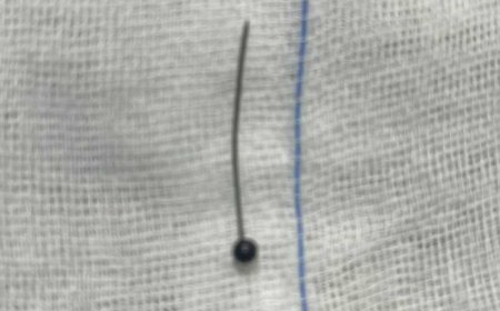 إنقاذ فتاة ابتلعت «دبوس حجاب» بمستشفى جامعة المنوفية