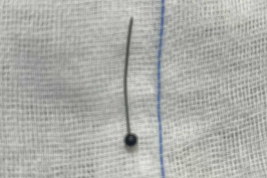 إنقاذ فتاة ابتلعت «دبوس حجاب» بمستشفى جامعة المنوفية